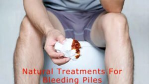 Natural Treatments For Bleeding Piles