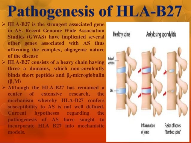 ankylosing-spondylitis-treatment