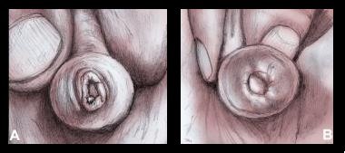 Phimosis