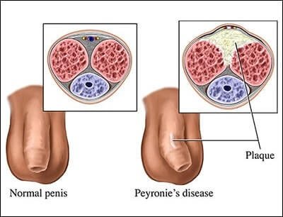 Peyronie’s Disease Treatment Ayurveda In India
