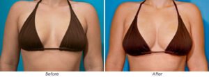 Breast before after 