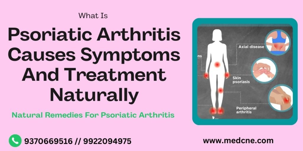 Psoriatic Arthritis Causes Symptoms And Treatment Naturally