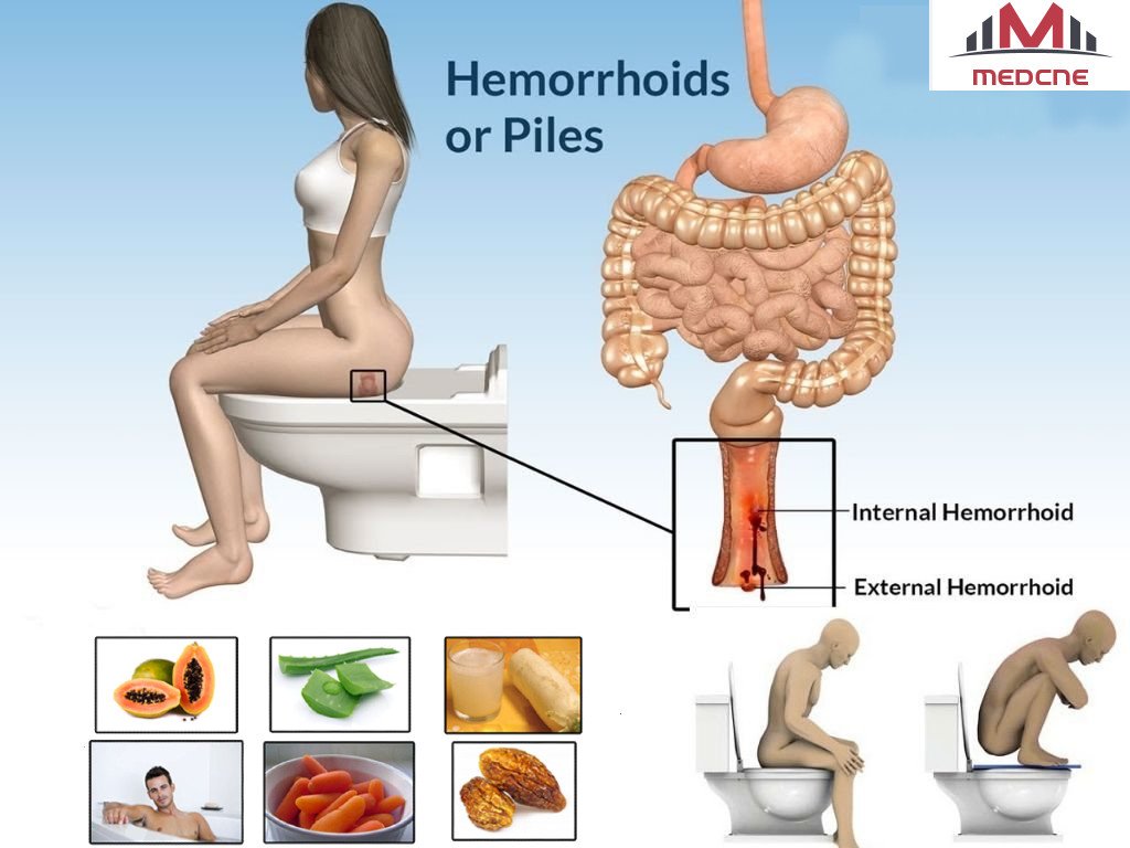 What is Piles?